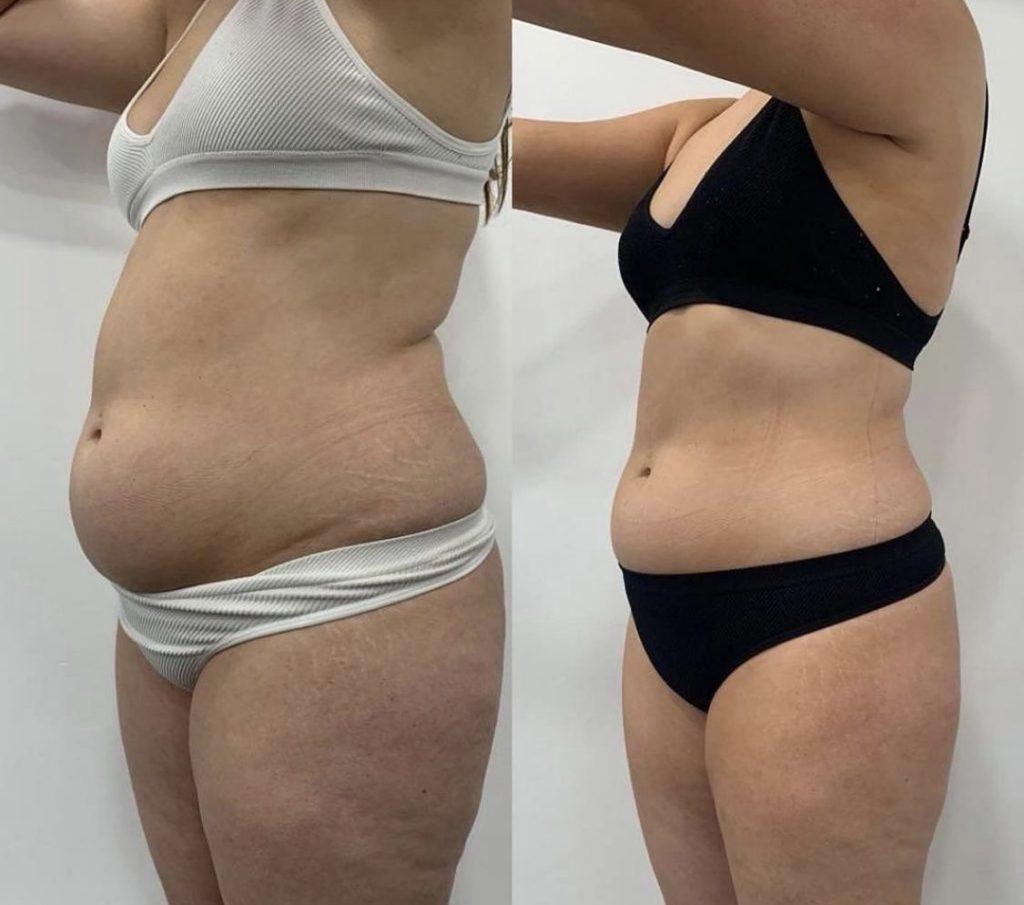 Gentle Glo before and after results - Abdomen & Waist body contouring League City TX